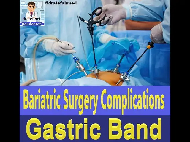 Video thumbnail for Bariatric Surgery Complications /Gastric Band Complications/ Sleeve Gastrectomy/ Weight loss surgery