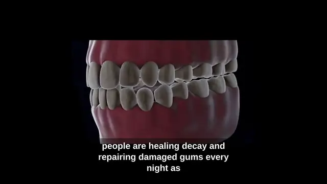 'Video thumbnail for 1 Simple Secret Reverses Tooth Decay & Rebuilds Your Gums'