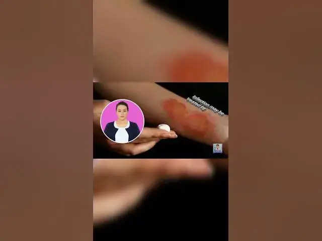 Video thumbnail for Antibiotics in burn #burn #antibiotics #shorts #lifes1 s #no1doctor #frcs #medical_student_exam