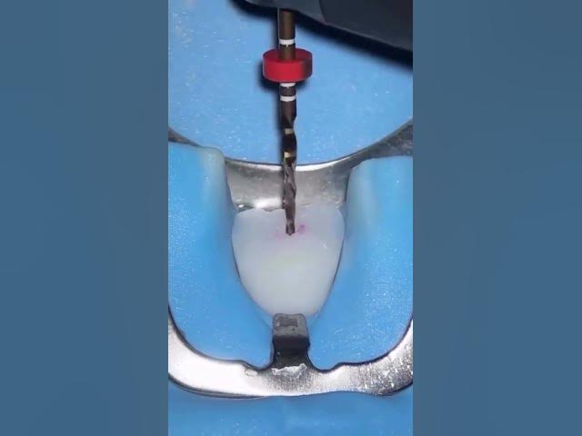 Video thumbnail for broken file retrieval #dentaleducation #satisfying #dentalhealth #dentalartistry #dentist