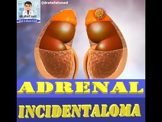 Video thumbnail for Adrenal Incidentaloma/ Adrenals lecture / Adrenal Incidentaloma Guidelines/No1doctor/dratef
