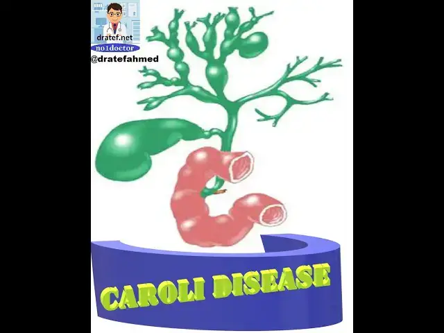 Video thumbnail for Caroli Disease /Caroli’s Syndrome / Caroli’s Disease/ Cogenital Biliary Disease / choledochal cyst