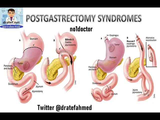 Video thumbnail for Postgastrectomy complications /Duodenal stump leak/Stricture/Obstruction/Afferent  efferent loop