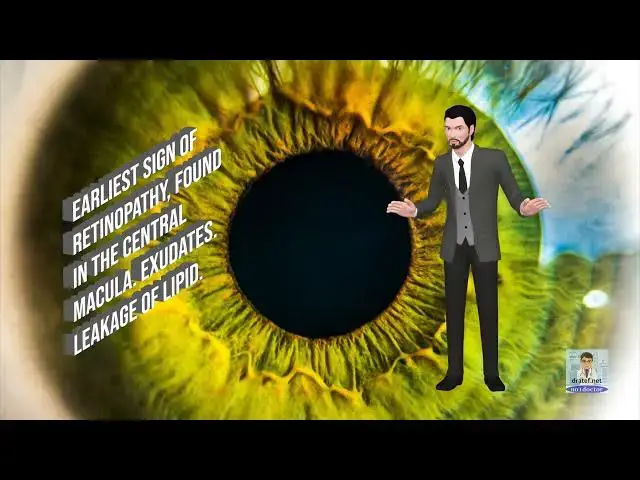 Video thumbnail for Diabetic Retinopathy