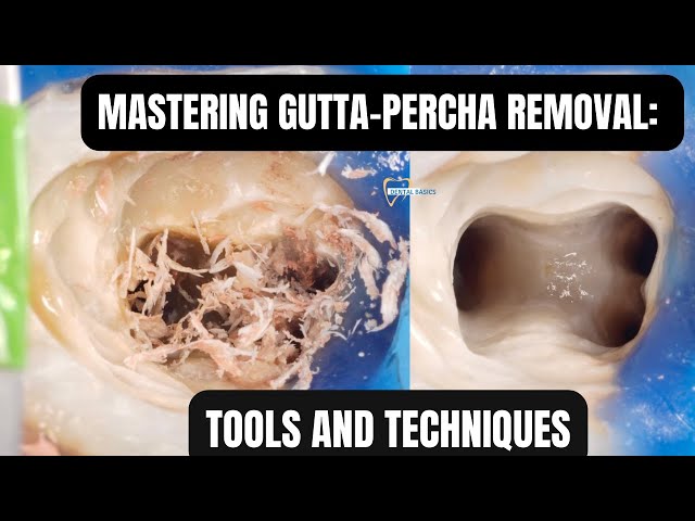 Video thumbnail for Clinical Tips for easy Gutta-Percha Removal | Endodontic Retreatment