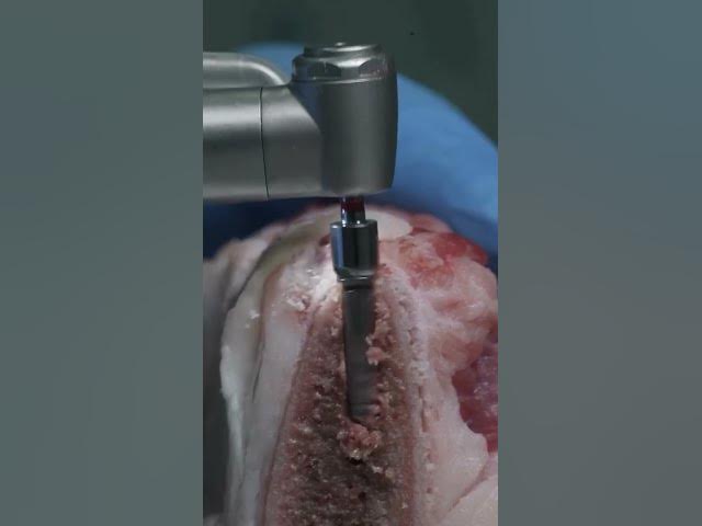 Video thumbnail for dental implant procedure #dentaleducation #satisfying #dentalhealth #dentalprosthesis