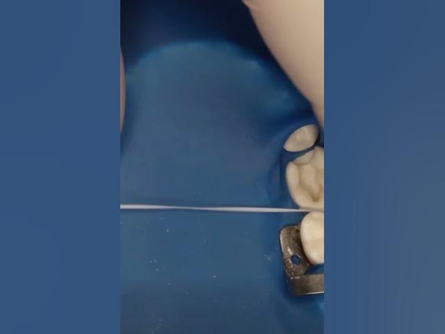 Video thumbnail for rubber dam  Inversion with Dental Floss