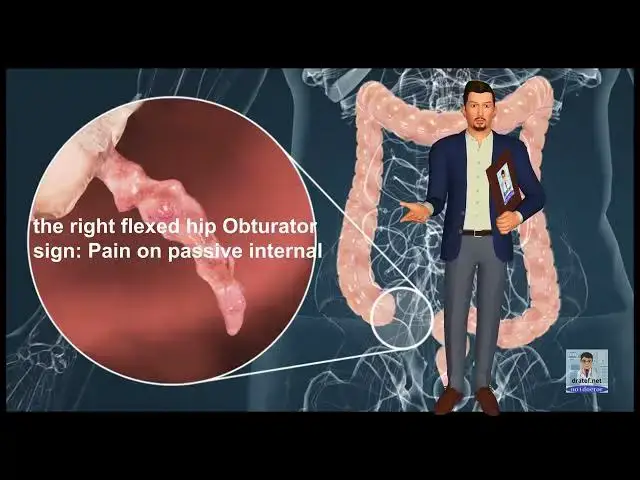 Video thumbnail for Appendicitis